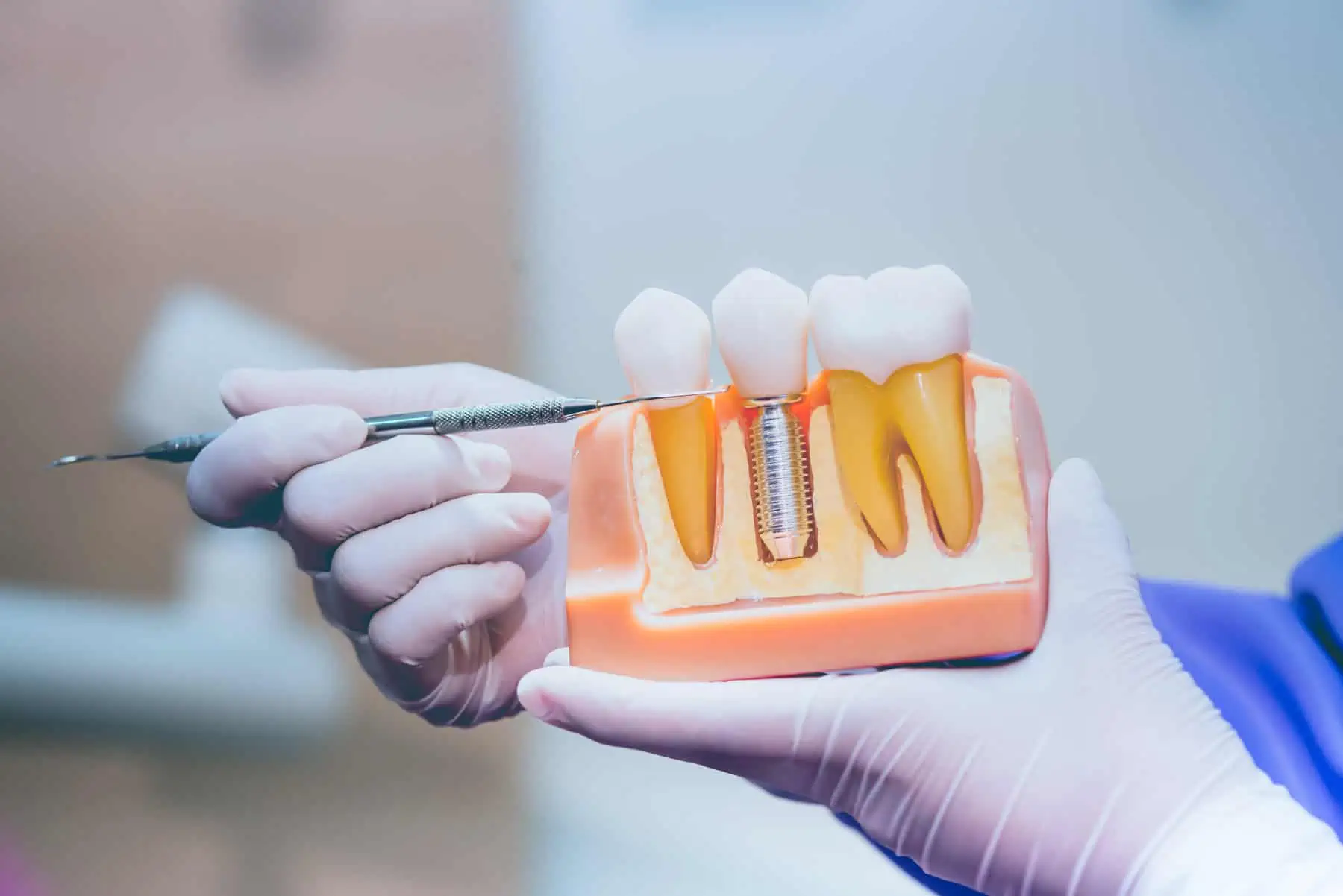 Implant Dentistry Services